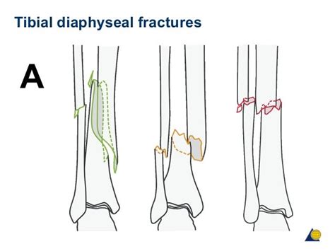 425A became effective on October 1, 2023. . Icd 10 code for distal fibular fracture